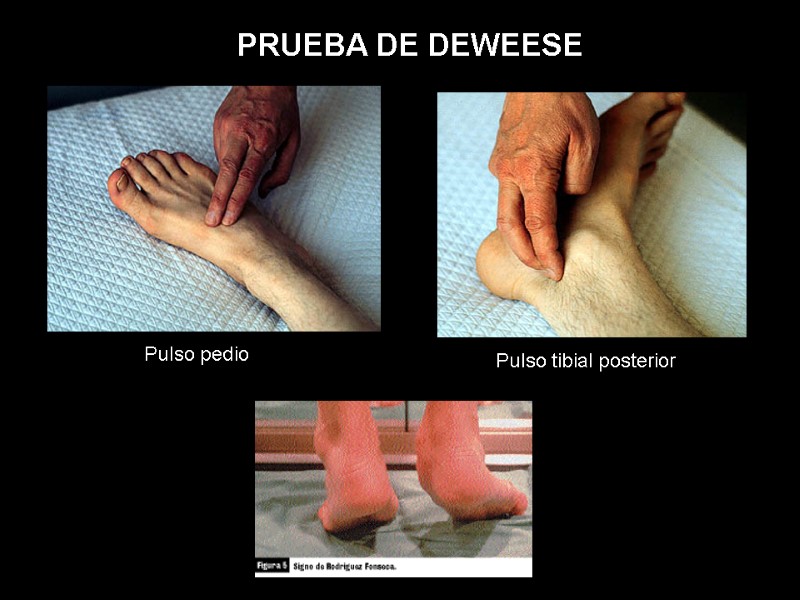 Pulso pedio  Pulso tibial posterior  PRUEBA DE DEWEESE